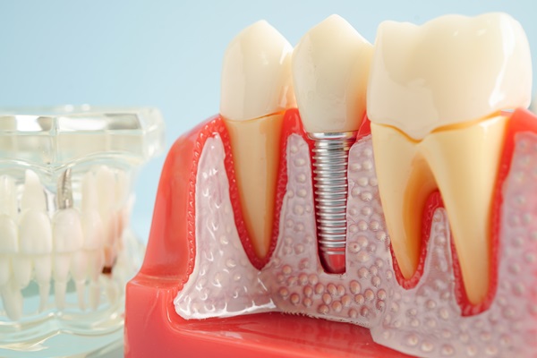 How Is A Dental Implant Placed?