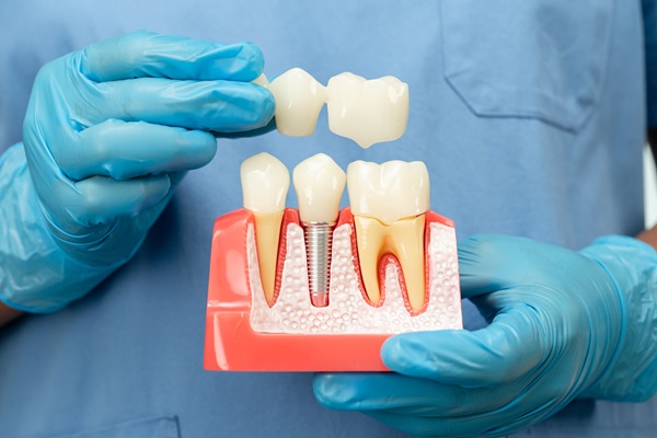 How Long Do Dental Implants Crowns Last?